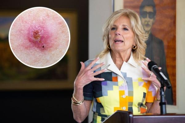 جراحی همسر رئیس جمهور آمریکا برای یک نوع شایع سرطان پوست